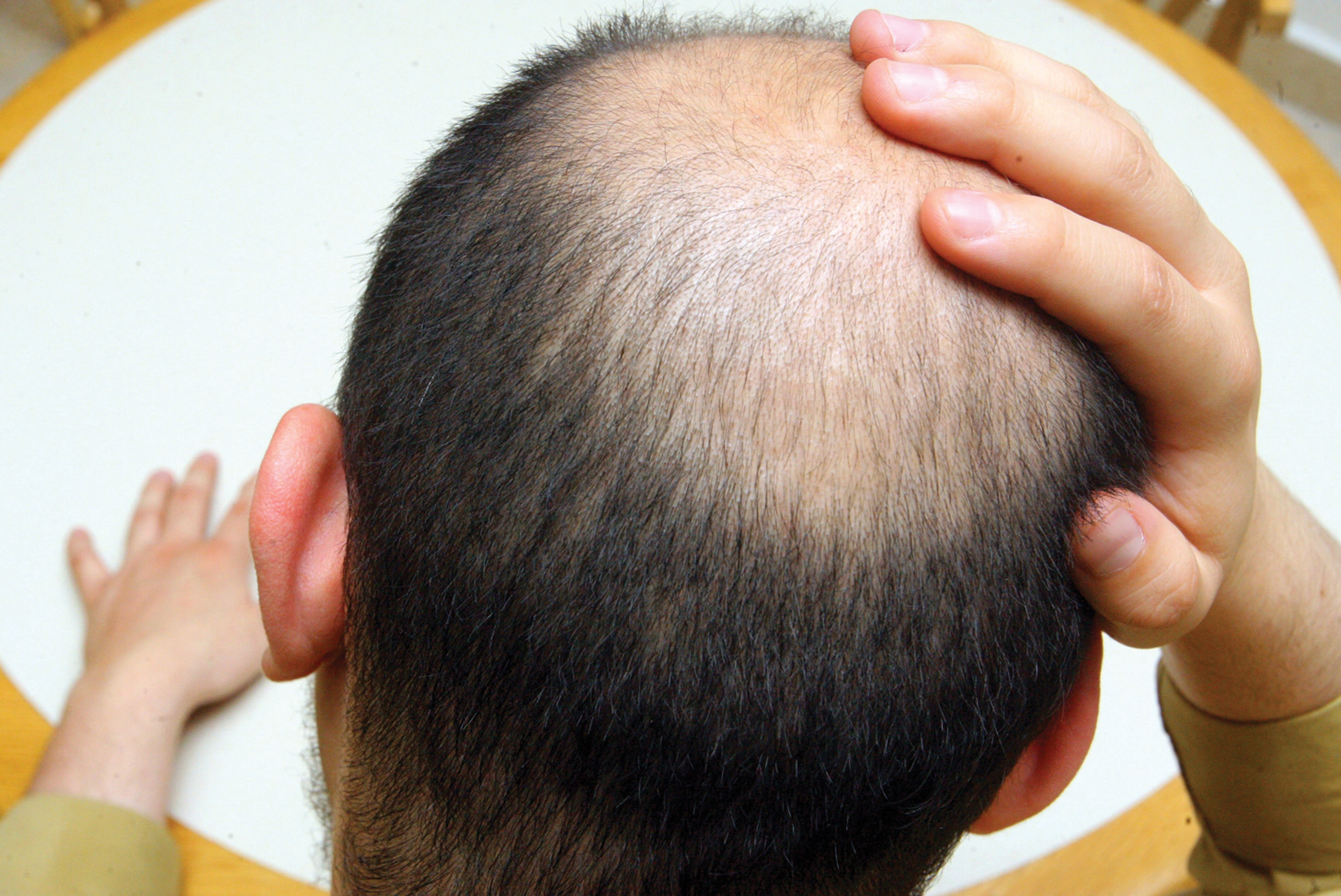 Combate la ca&iacute;da del cabello